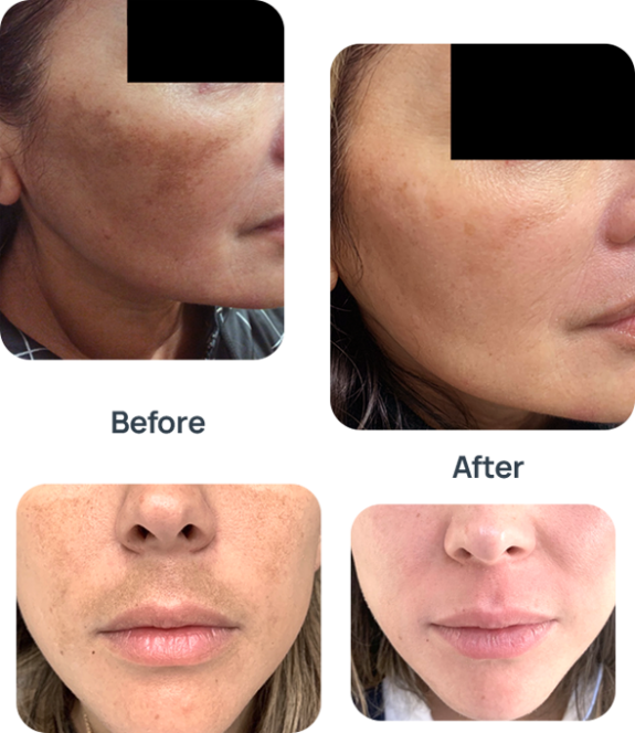 Face cream jar, hydroquinone-free.