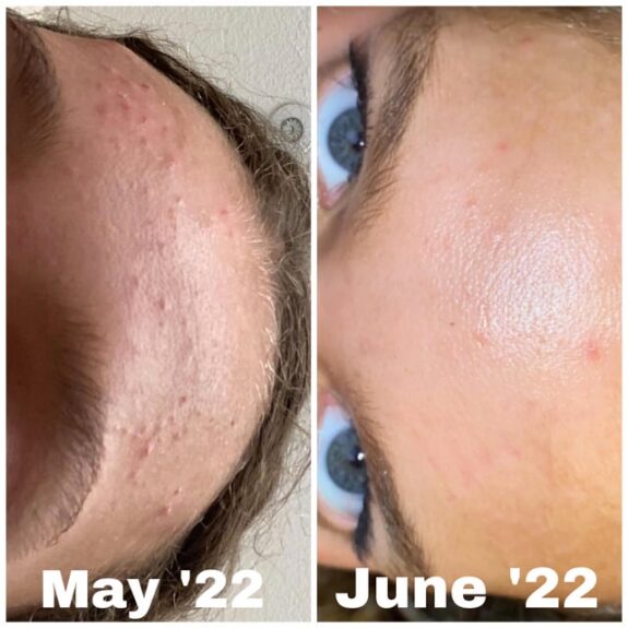 Cerave Tretinoin acne treatment cream.