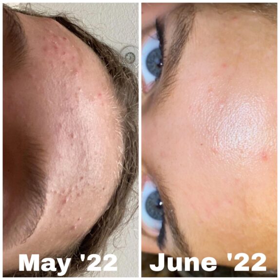 Cerave Moisturizing Cream with Tretinoin.