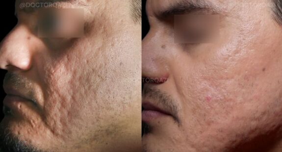 Tretinoin cream for scar treatment.