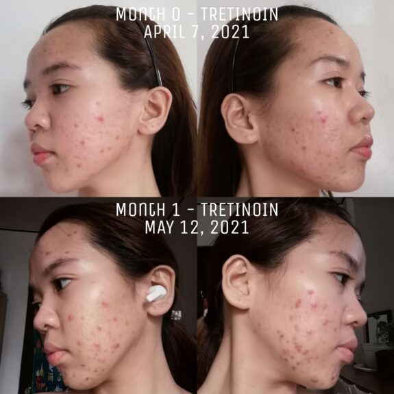 Tretinoin Uglies Reddit: Before & After photos showcasing skin improvement.