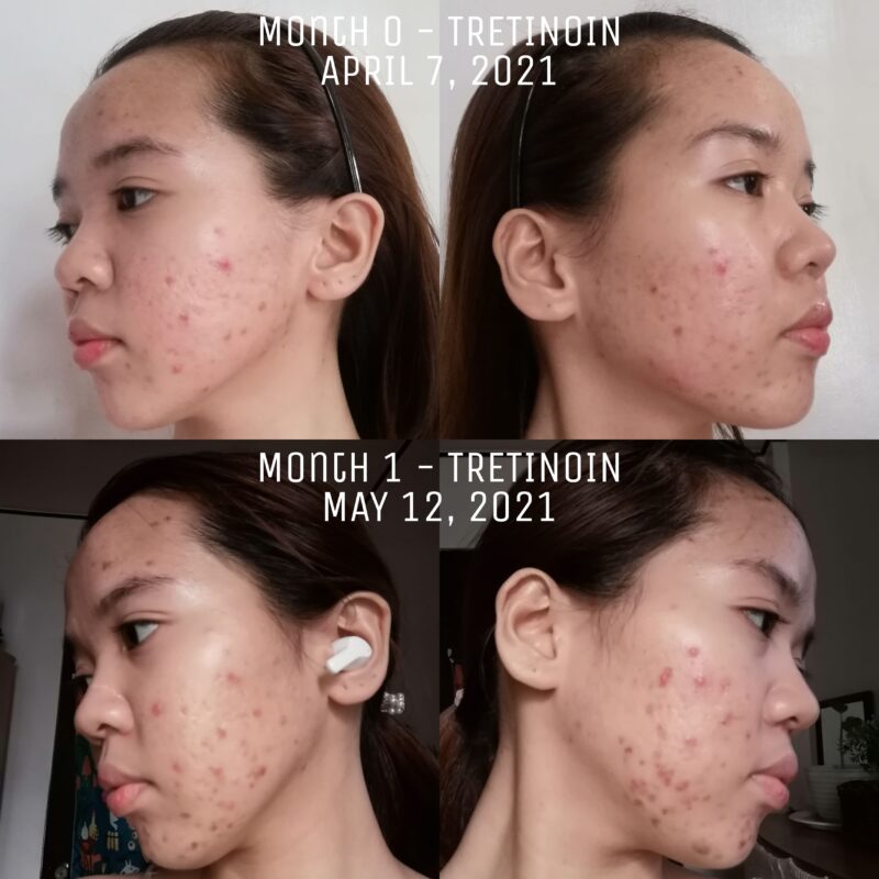 Tretinoin Uglies Reddit: Before & After photos showcasing skin improvement.
