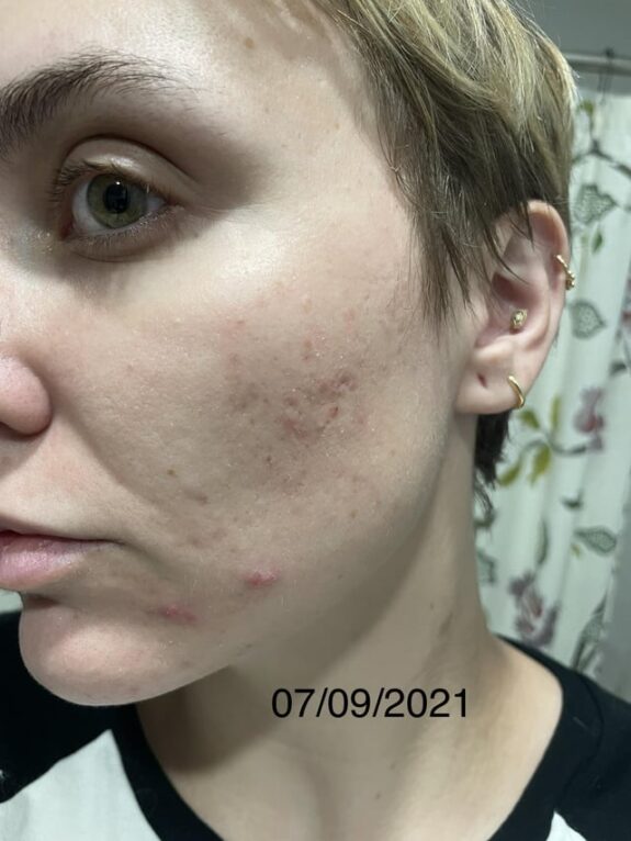 Tretinoin gel tube.