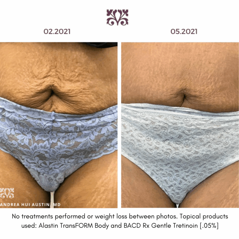 Tretinoin 0.05% before & after results. See visible skin improvement.