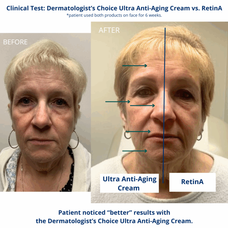 Tretinoin cream before & after: reduced wrinkles.