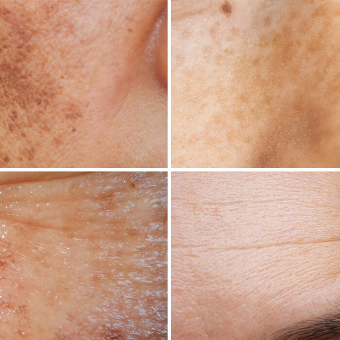 Tretinoin cream for sun-damaged skin.
