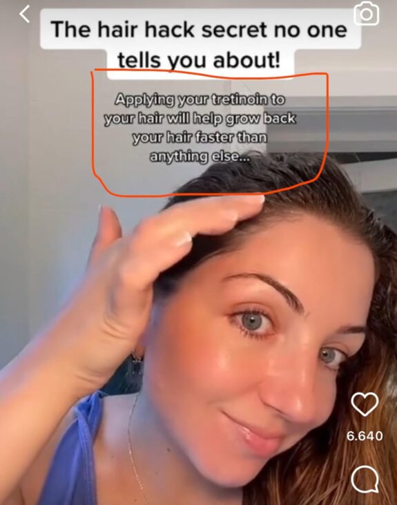 Tretinoin scalp treatment.