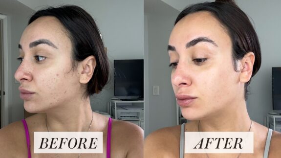 Tretinoin before & after: improved skin texture & tone.