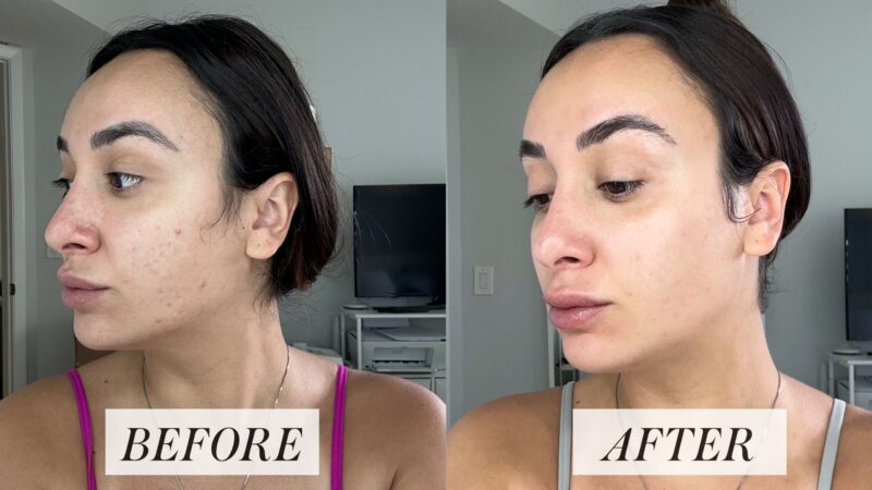 Tretinoin before & after: improved skin texture & tone.