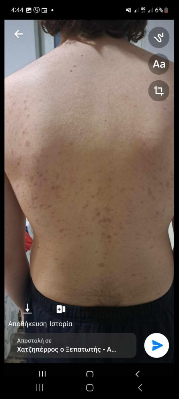 Tretinoin cream for back acne treatment.