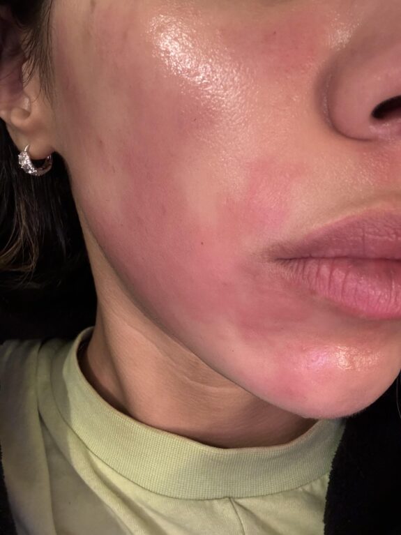 Tretinoin cream burn: irritated skin showing redness and potential peeling.