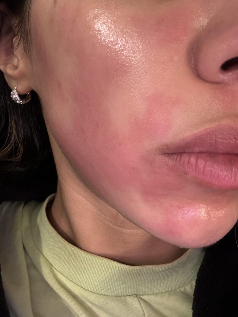 Tretinoin cream burn: irritated skin showing redness and potential peeling.