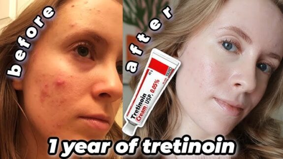 Tretinoin gel before & after: showing improved skin texture & tone.