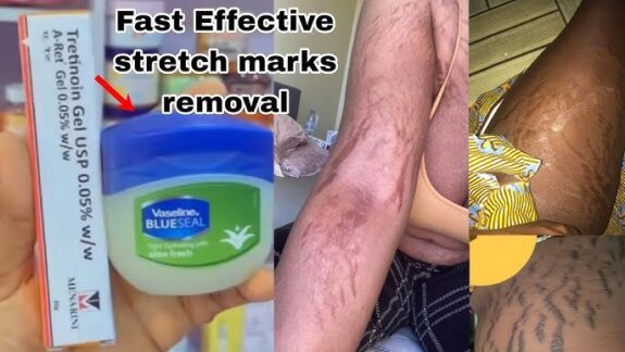 Tretinoin Stretch Mark Cream jar
