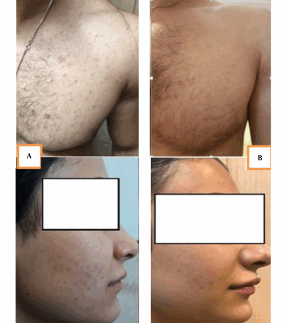 Clindamycin Phosphate & Tretinoin Gel for wrinkles.