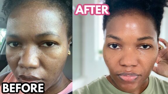 Tretinoin cream for dark skin.
