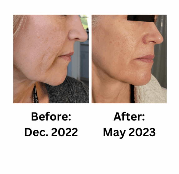 Tretinoin skin tightening cream