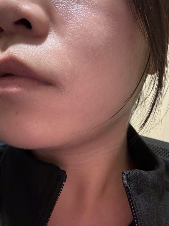 Tretinoin cream for nasolabial folds.