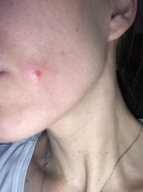 Tretinoin cream applied to acne.