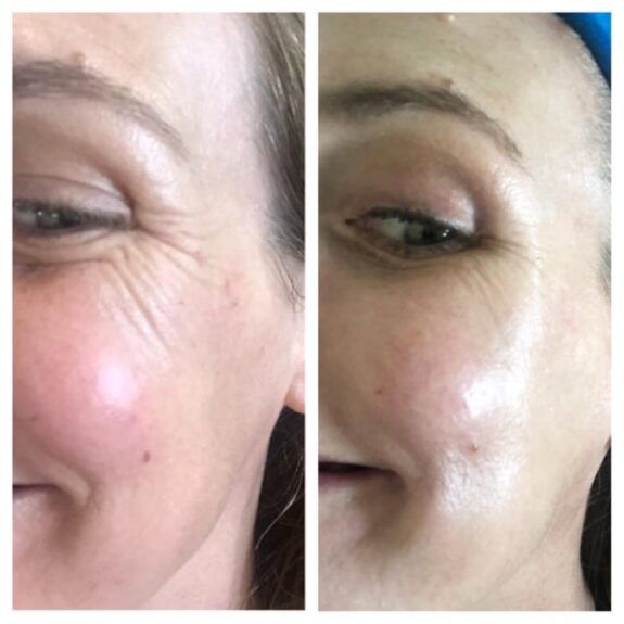 Tretinoin cream for crows feet wrinkle treatment.