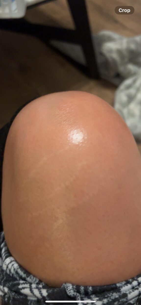 Tretinoin cream for stretch mark reduction.