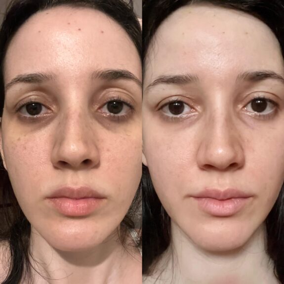 Tretinoin cream for dark circles.
