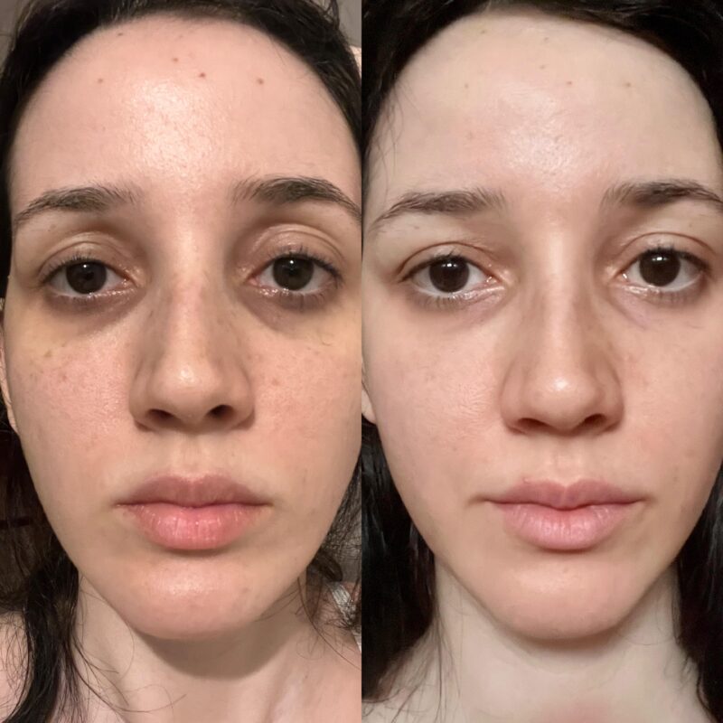 Tretinoin cream for dark circles.