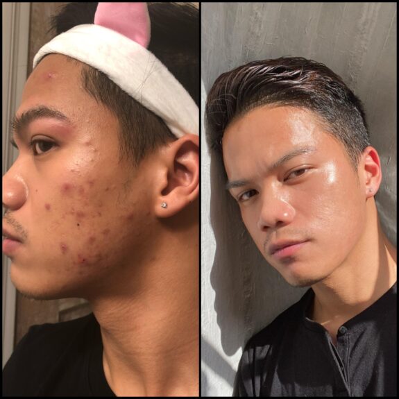 0.1% tretinoin cream tube