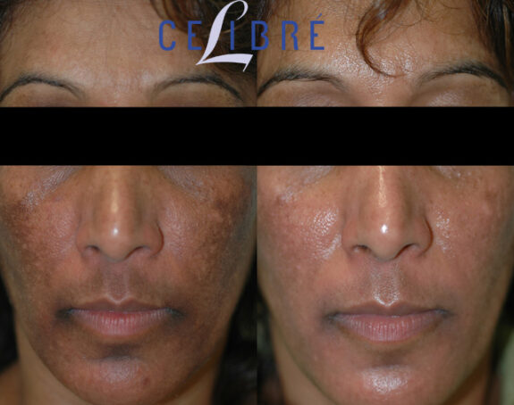 Hydroquinone 6% before & after skin treatment results.