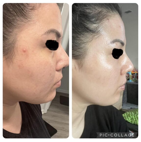 Tazorac acne treatment for rosacea.