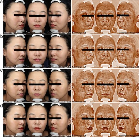 Hydroquinone Monotherapy & Triple Combination Cream tubes