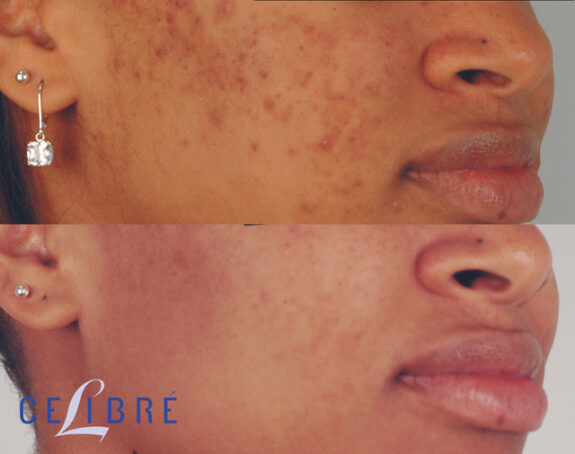 Hydroquinone scar treatment cream.