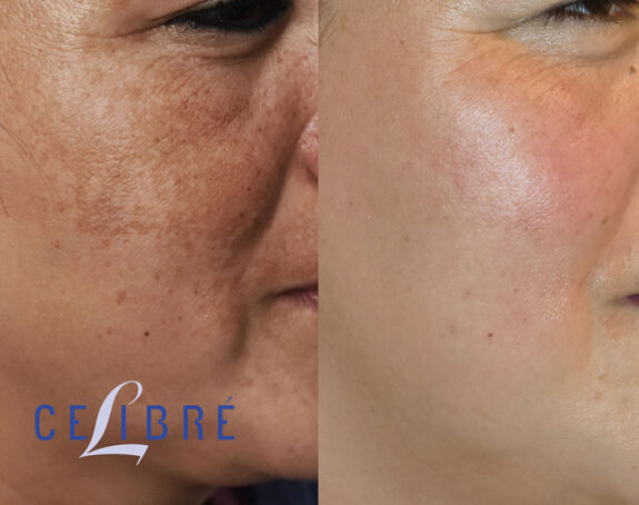 Hydroquinone 8% cream before & after results.