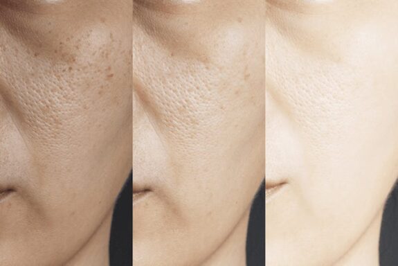 Before & After: Hydroquinone Cream, skin lightening treatment.