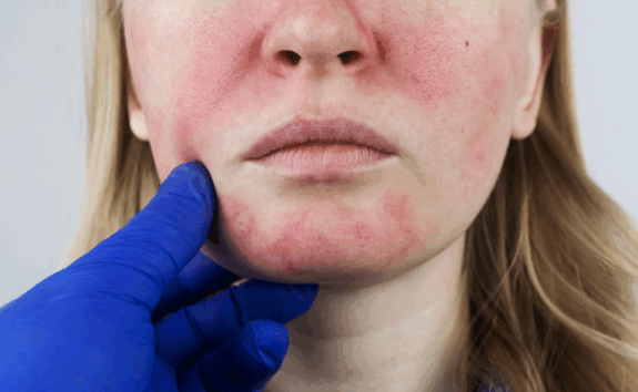 Hydroquinone Plus Cream: Side Effects information.