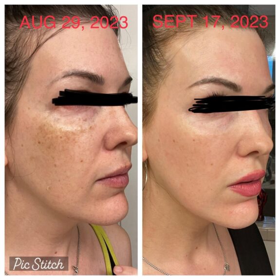Hydroquinone 4% skin lightening cream.