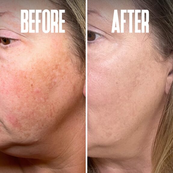 Hydroquinone cream for freckle treatment.