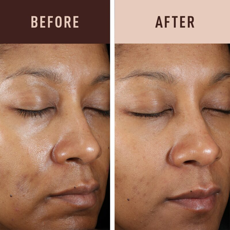 Before & after photos showing results from 4 Hydroquinone cream use.