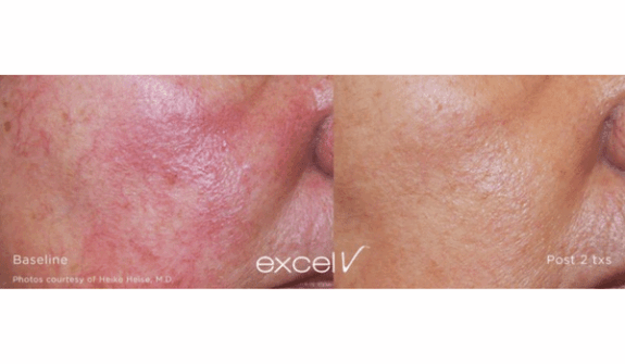 Hydroquinone Cream for Redness Relief