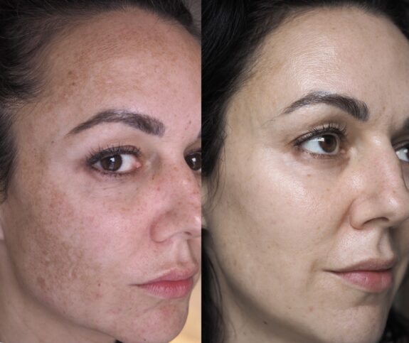 Hydroquinone cream for hypopigmentation treatment.