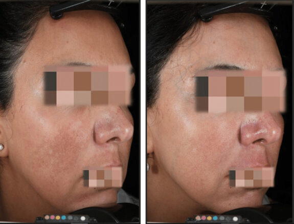 Tri Luma Under Eye Circles treatment.