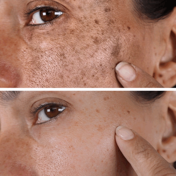 Dark Spot Remover Hydroquinone cream.