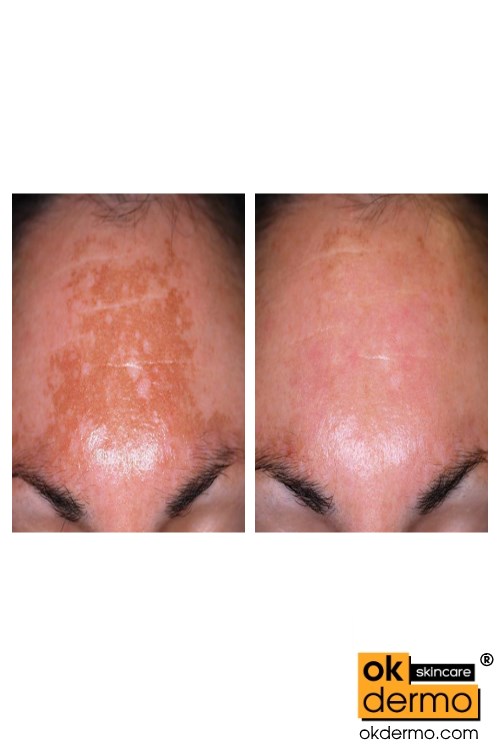 Melacare Hc Cream tube.