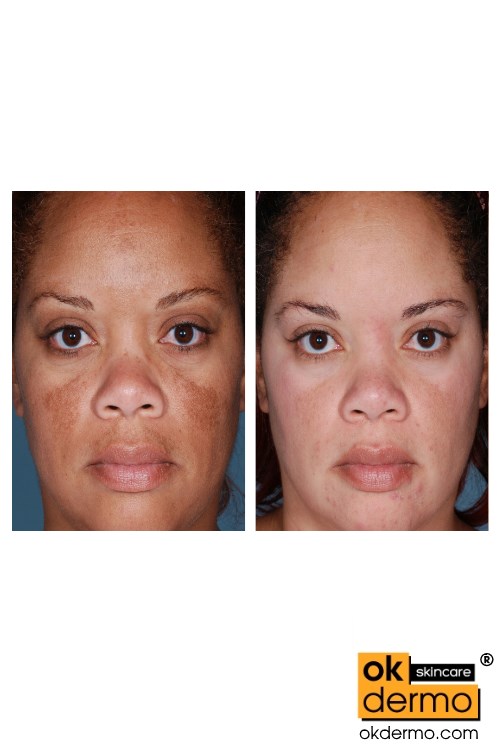 Hydroquinone Whitening cream, skincare product.