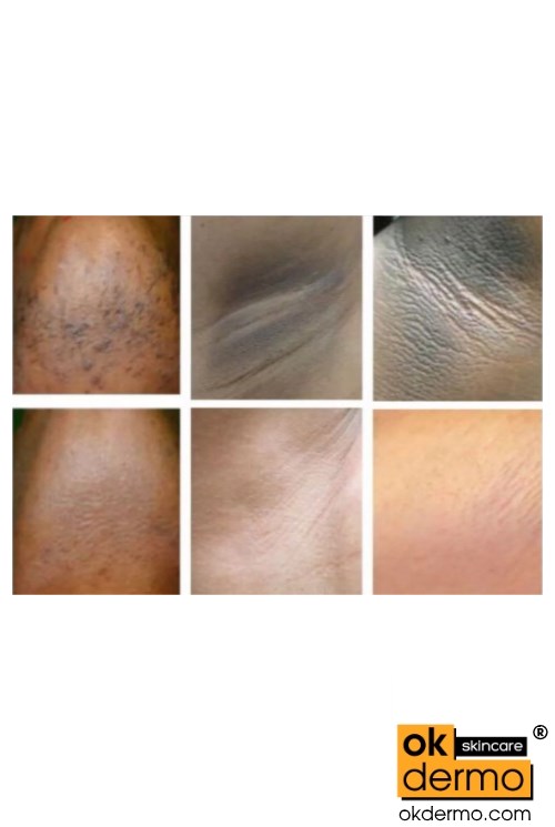 Hydroquinone Bikini Area lightening cream.