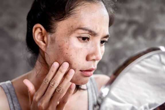 Hydroquinone cream for sunspot treatment.