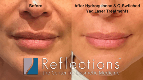 Hydroquinone cream for upper lip hyperpigmentation.