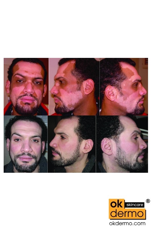 Benoquin and Hydroquinone topical cream.