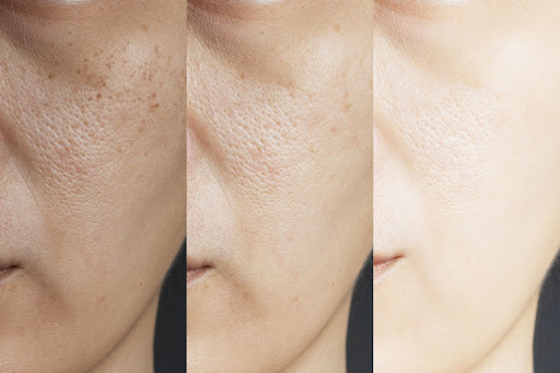 Hydroquinone skin treatment product.