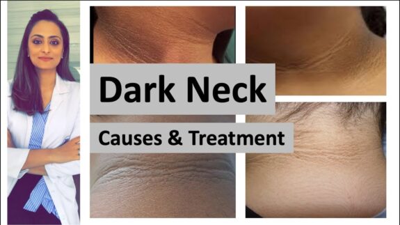 Hydroquinone cream for dark neck treatment.